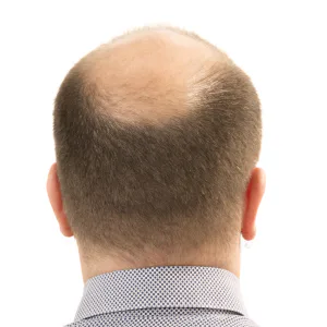 Hereditary hair loss