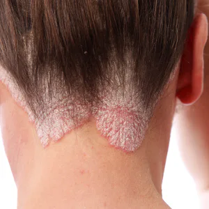 Scalp fungal infection
