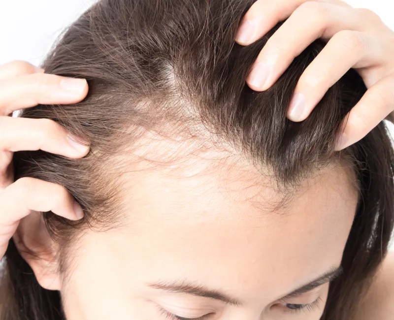 Scalp parting