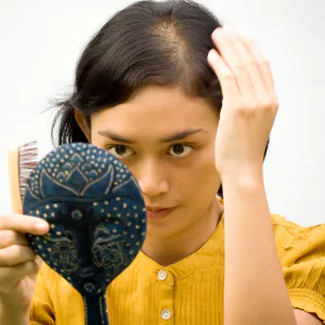 Hereditary hair loss