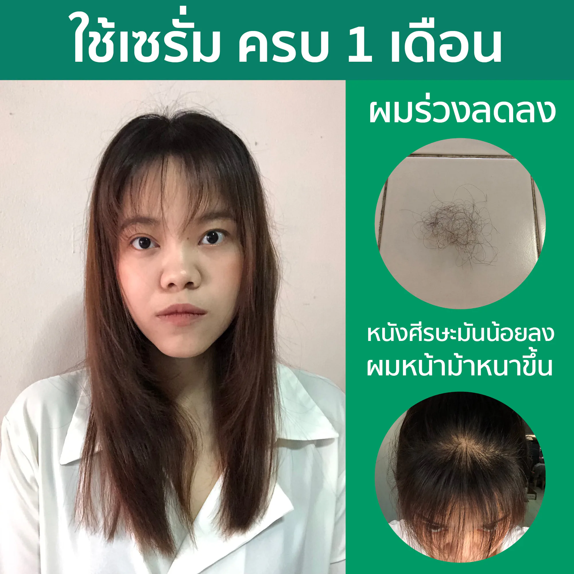 ဒီဆီရမ်လေးက ဆံပင်ကြွေမှုနဲ့ ဆံပင်မြောက်မှု လျော့ပေးနိုင်တယ် - AloEx ဆံပင်ကြွေမှုရပ်တန့်ပြီး ဆံပင်ပါးလာမှု လျော့ကျ ဆံပင်သစ်ပေါက်ပြီ