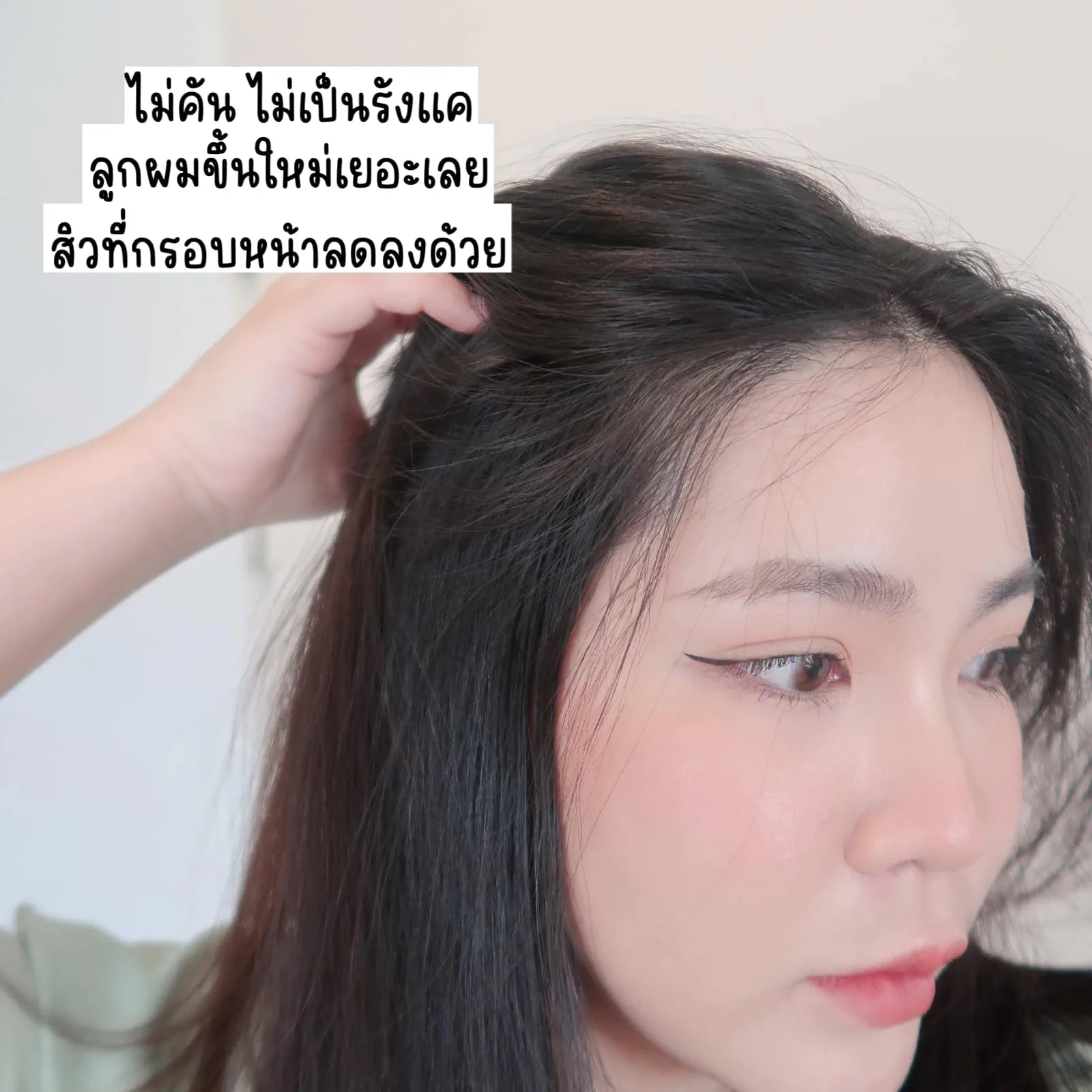 သွားရေးရောဂါ (Seborrheic Dermatitis) ဖြစ်တတ်သူတွေ ဦးရေပြားယားတတ်တာ သိကြပါလိမ့်မယ်။ AloEx ဆံပင်ကြွေကျမှုလျော့ချရေးမှာ နာမည်ကျော် AloEx Extra Mild နဲ့ တွေ့ကြုံမှ ဒီလောက်သာဆိုတာ သိရပါတယ် - AloEx ဆံပင်ကြွေမှုရပ်တန့်စေ၊ ဆံပင်ပါးမှုလျော့ပါ့စေ၊ ဆံပင်အသစ်ပေါက်စေ