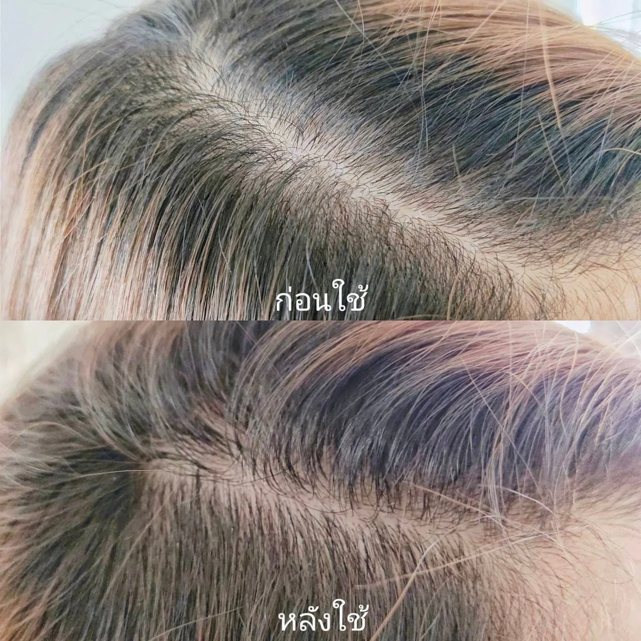 AloEx ဆီဟာ ဆံပင်ကြွေမှု လျော့ကျစေဖို့ အများကြီး ကောင်းမွန်တာ - AloEx ဆံပင်ကြွေမှုရပ်ဆိုင်း၊ ဆံပင်ပါးလွှာမှုလျော့ကျ၊ ဆံပင်သစ်ပေါက်