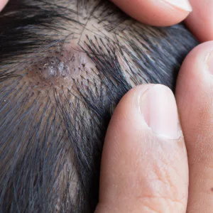 Scalp fungal infection