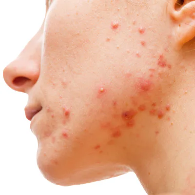 Clogged-pore acne and bumps