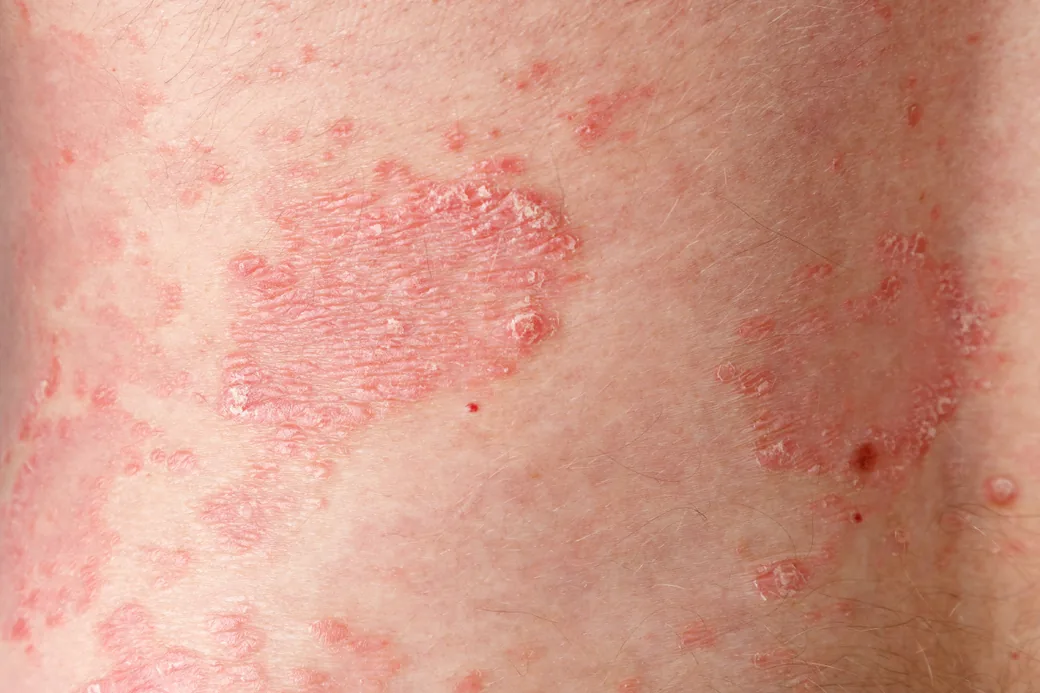 Mảng vảy nến — các mảng đỏ dày, viền rõ nét, phủ lớp vảy trắng bạc