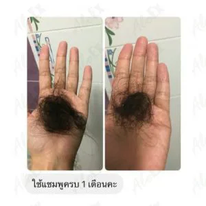 AloEx Shampoo Before & After Reviews