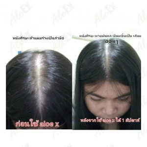 หนังศีรษะหายมันและมีเส้นผมขึ้นเป็น เส้นอ่อนๆ