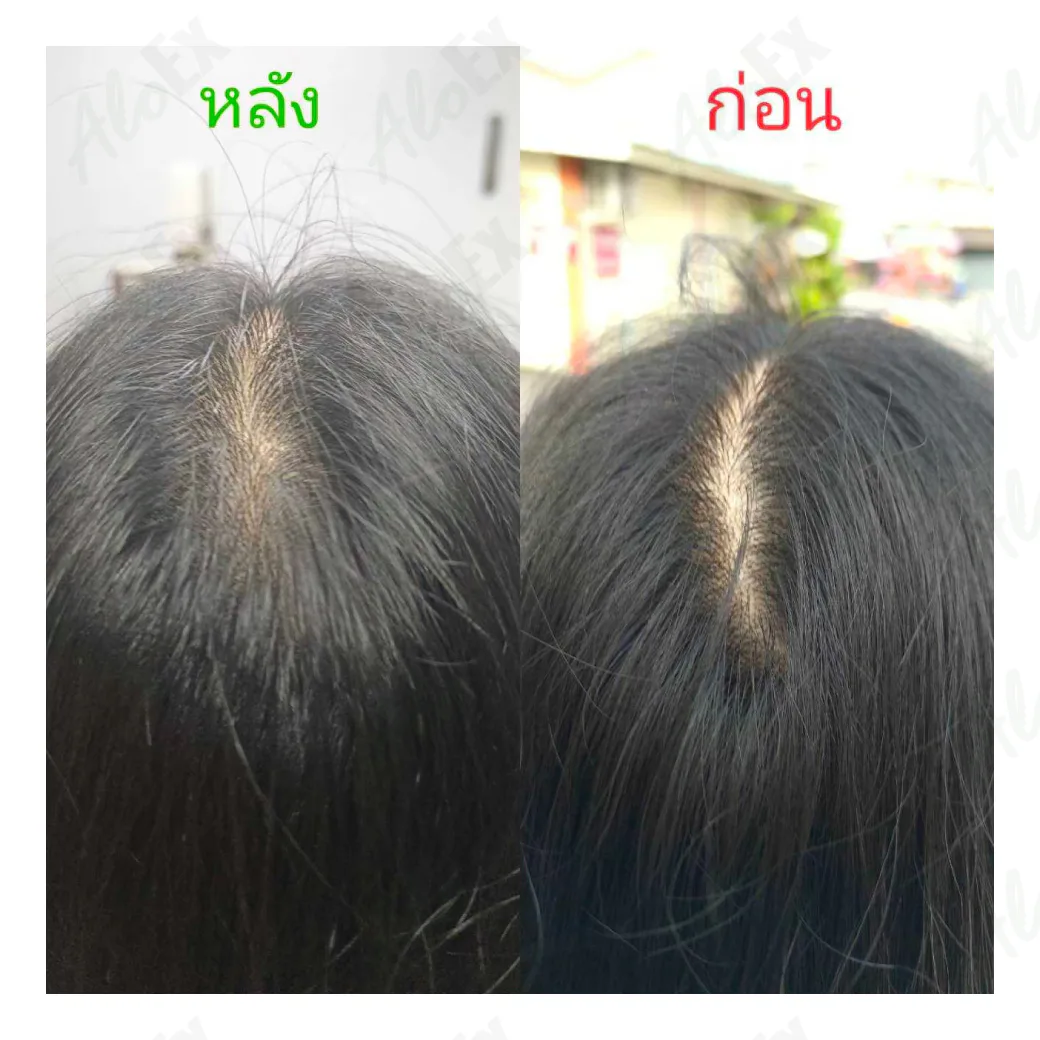 မသုံးမီနှင့် သုံးပြီးနောက် — AloEx ထုတ်ကုန်များ