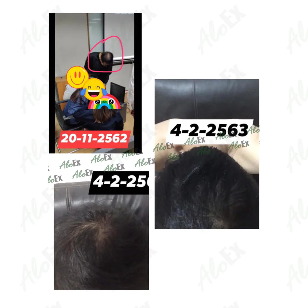 မသုံးမီနှင့် သုံးပြီးနောက် — AloEx ထုတ်ကုန်များ
