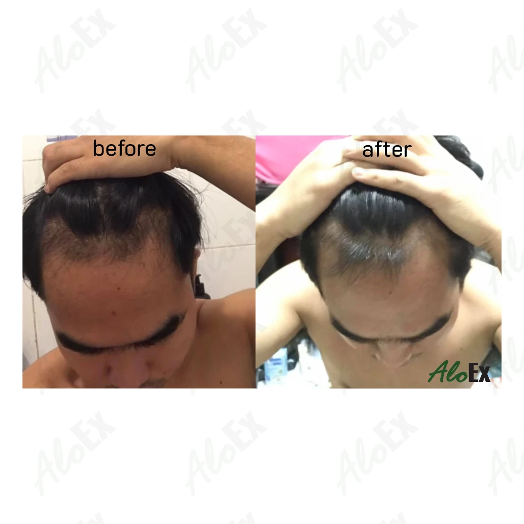 မသုံးမီနှင့် သုံးပြီးနောက် — AloEx ထုတ်ကုန်များ