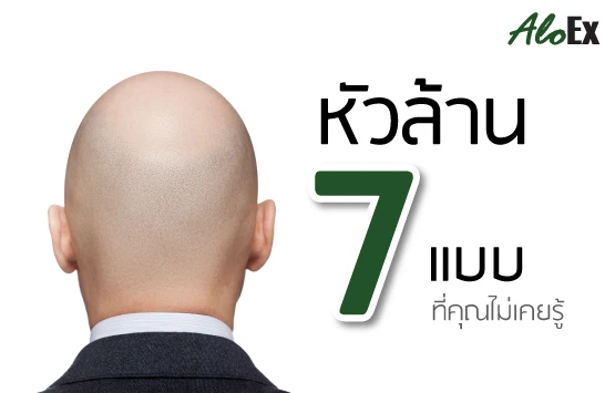 7 types of baldness
