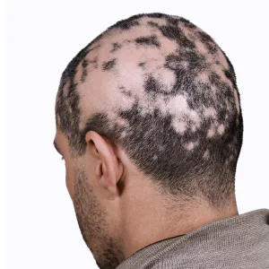 Thyroid-related hair loss