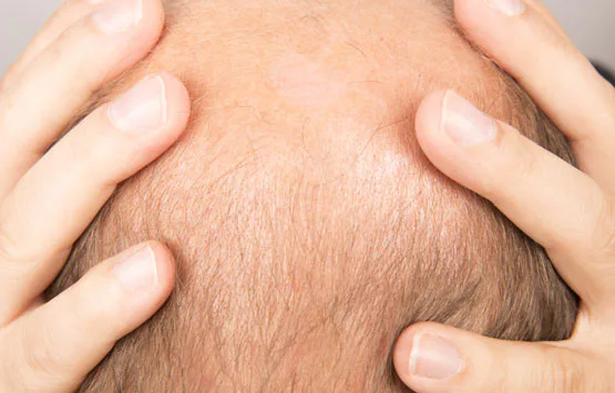 How to deal with hereditary hair loss and thinning
