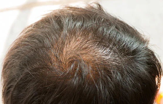 Tips for solving oily scalp for men