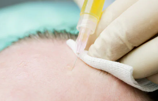 Hair-transplant innovation — the ACP method