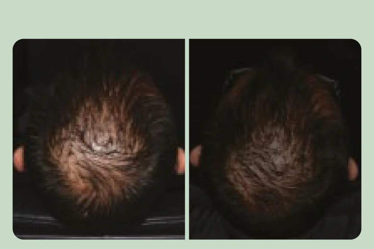 志愿者使用 Redensyl 三个月前后的对比照片，头顶发量明显变得更浓密