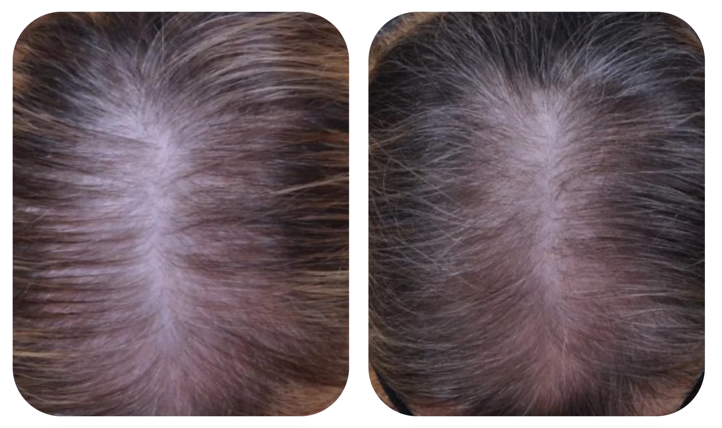 使用 AloEx Organic Intensive Hair Serum 前后的头皮对比，第 1 张
