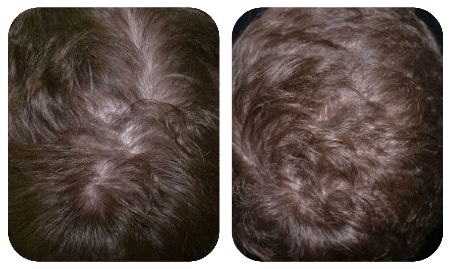 使用 AloEx Organic Intensive Hair Serum 前后的头皮对比，第 4 张