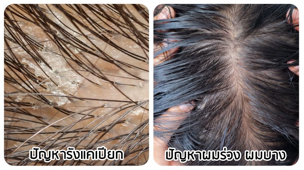 AloEx ผมมันทำให้เกิดรังแคและผมร่วง